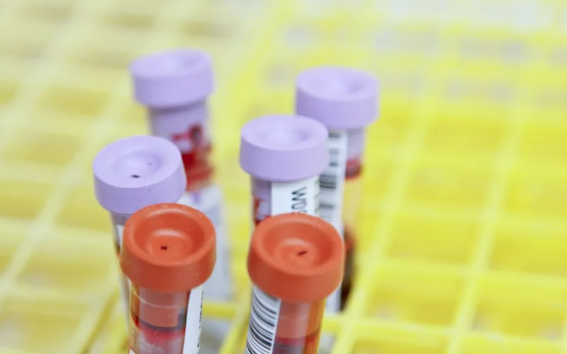 Blood sample tubes on a yellow rack in a medical lab